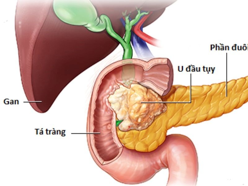 Căn bệnh ung thư tuyến tụy