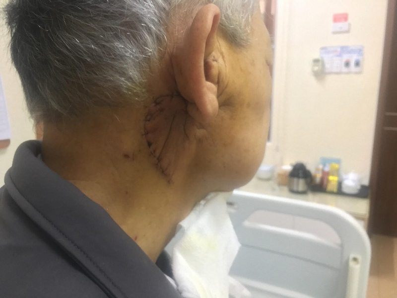 Căn bệnh ung thư tuyến nước bọt rất nguy hiểm