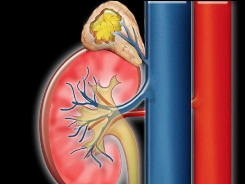 Nguyên nhân gây nên căn bệnh ung thư tuyến thượng thận