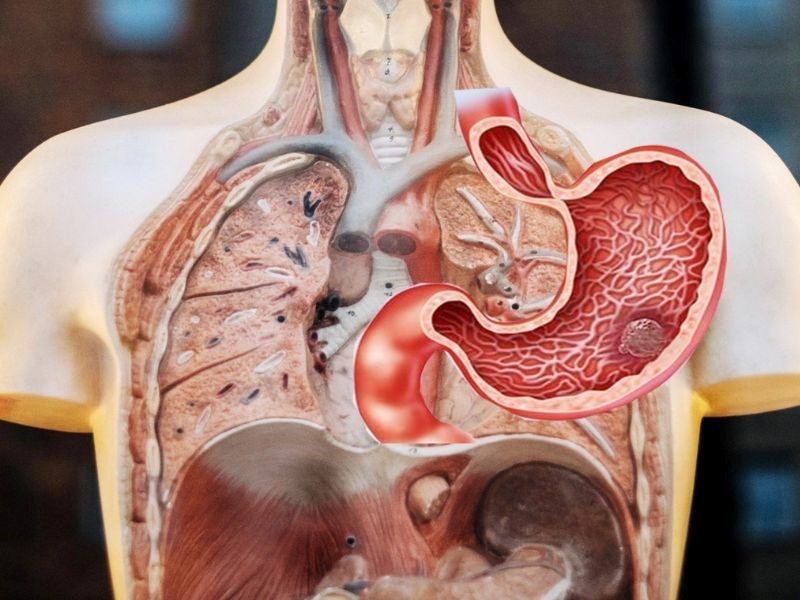 Ung thư dạ dày di căn tới nhiều bộ phận trong cơ thể