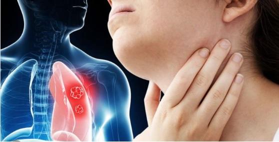 Xuất hiện hạch cổ