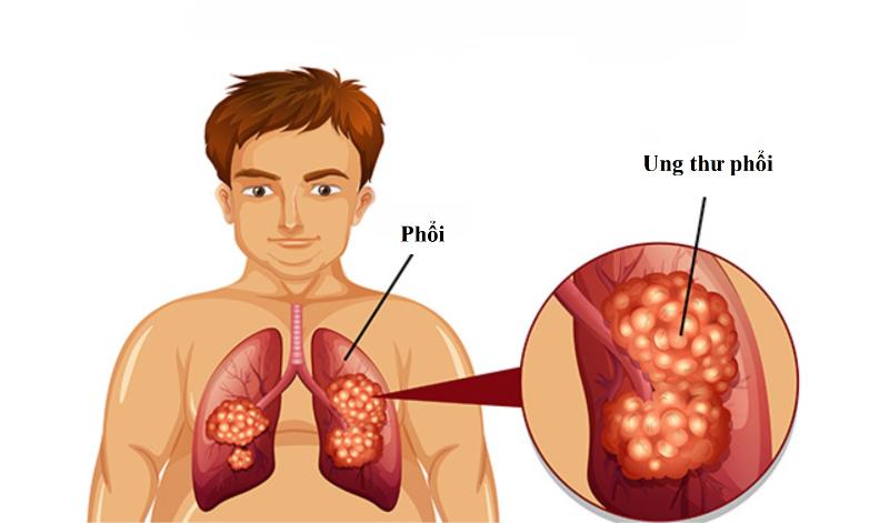 Tổng quan về ung thư phổi giai đoạn cuối