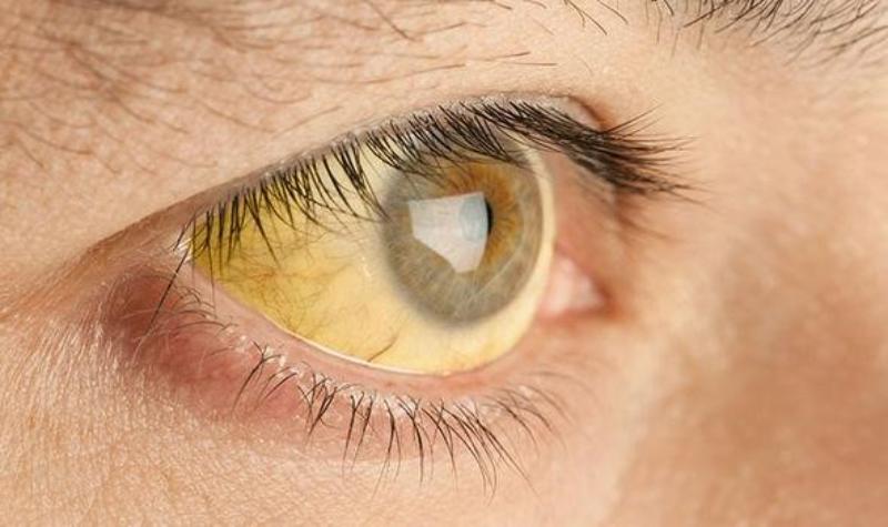 Triệu chứng ung thư phổi giai đoạn cuối khi đã di căn