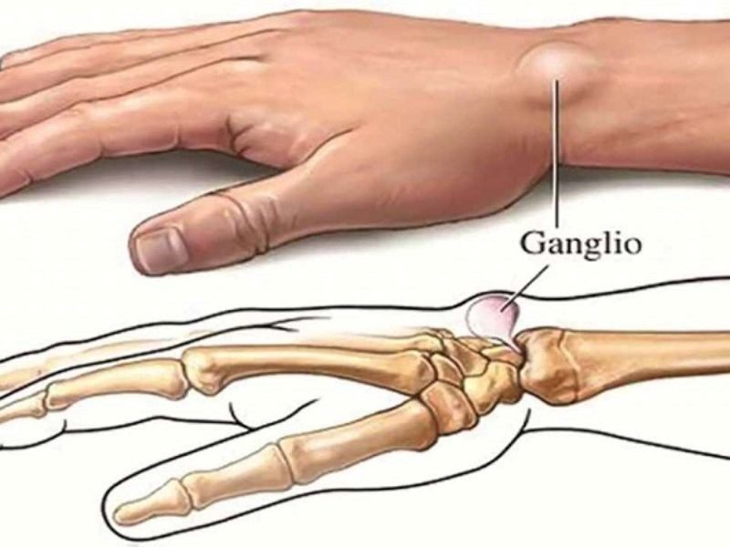 Bệnh nhân ung thư xương sống được bao lâu?
