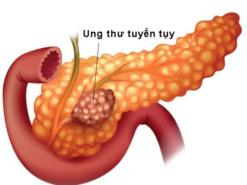 Các triệu chứng của căn bệnh ung thư tuyến tụy giai đoạn 4