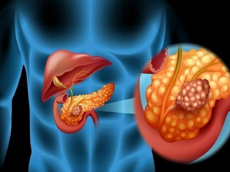 Căn bệnh ung thư tuyến tụy