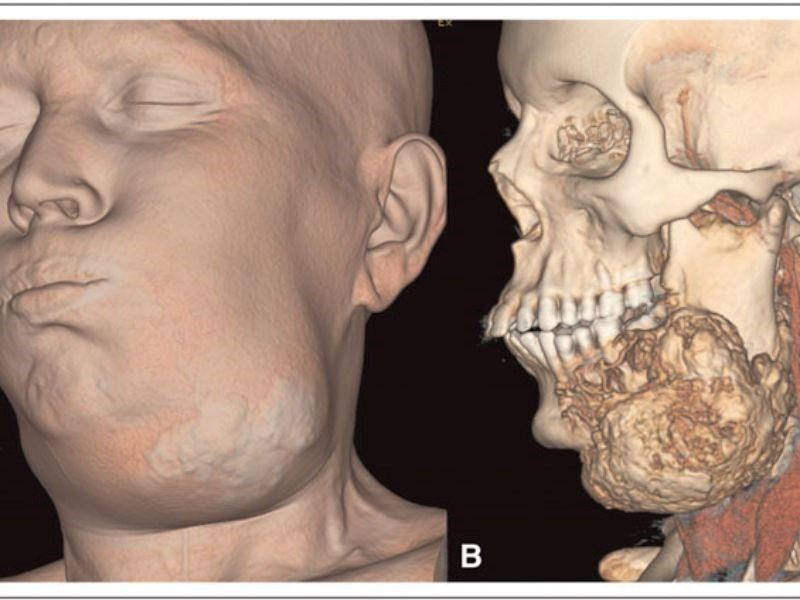 Căn bệnh ung thư xương hàm rất hiếm gặp