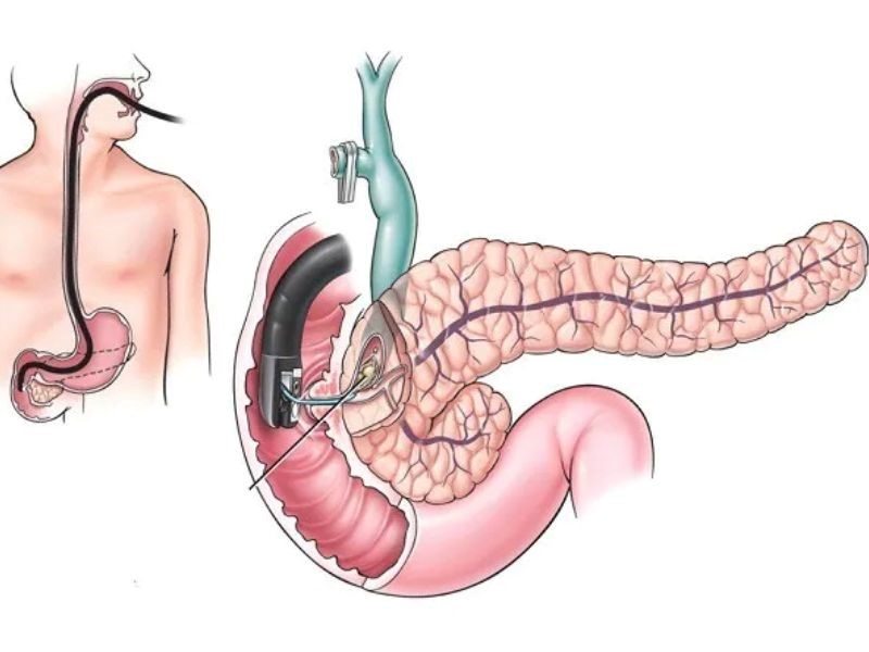 Dấu hiệu của căn bệnh ung thư tuyến tụy giai đoạn 2