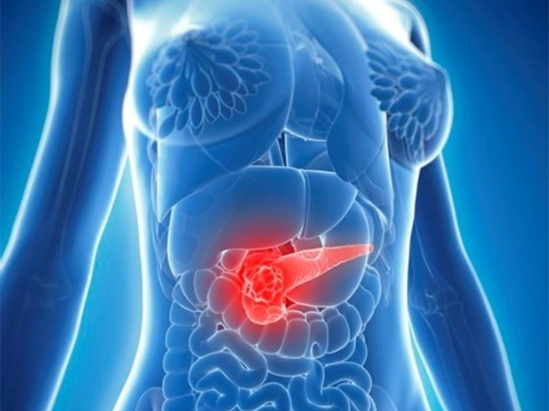 Dấu hiệu của căn bệnh ung thư tuyến tụy