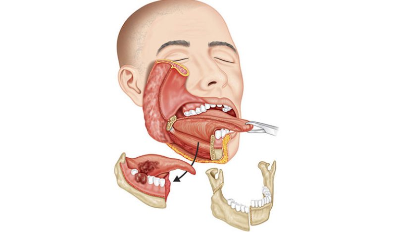 Điều trị ung thư xương hàm