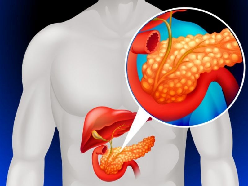 Nguyên nhân gây nên căn bệnh ung thư tuyến tụy