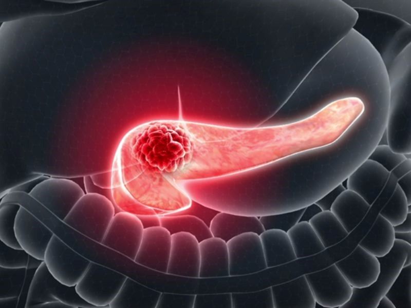 Phương pháp chẩn đoán ung thư tuyến tụy giai đoạn 4