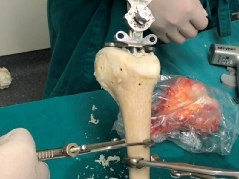 Thời gian sống của bệnh nhân ung thư xương phụ thuộc vào nhiều yếu tố