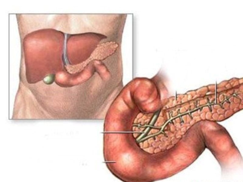 Ung thư tuyến tụy giai đoạn 2