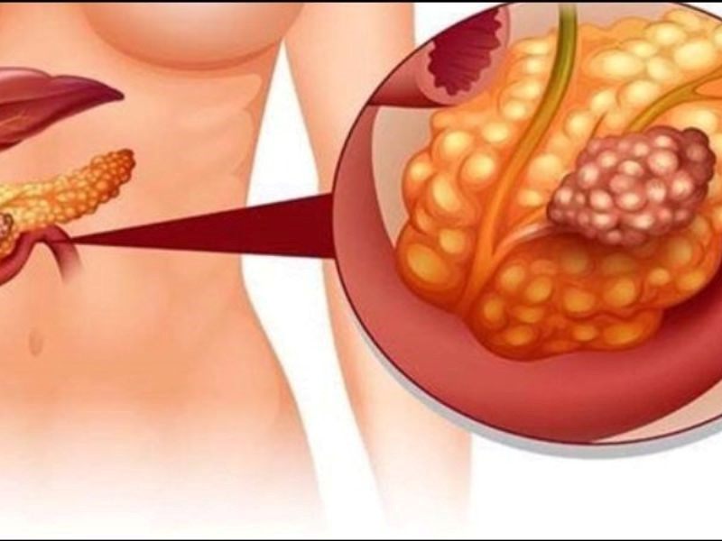 Ung thư tuyến tụy giai đoạn 4