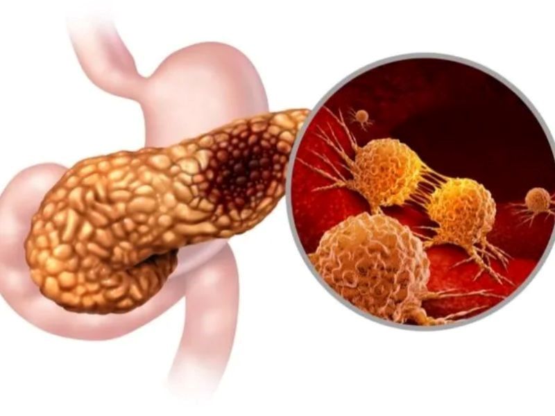 Ung thư tuyến tụy là căn bệnh rất nguy hiểm