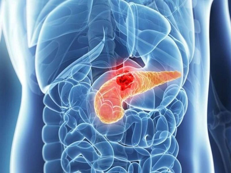 Ung thư tuyến tụy sống được bao lâu?