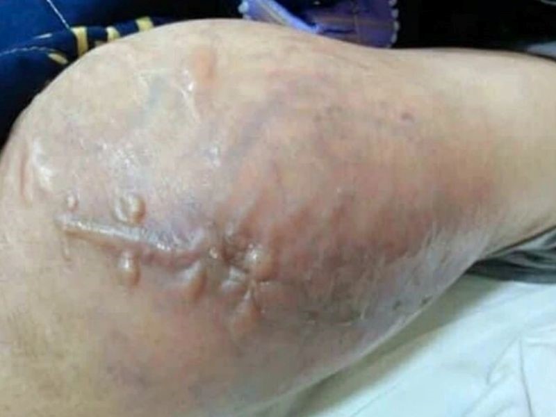 Ung thư xương giai đoạn cuối rất nguy hiểm