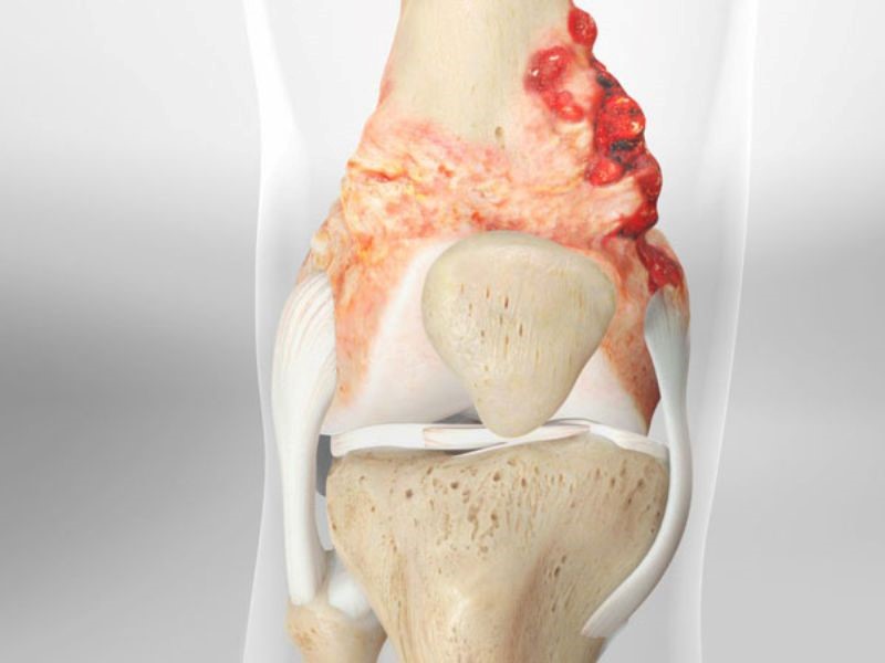 Ung thư xương giai đoạn cuối sống được bao lâu?