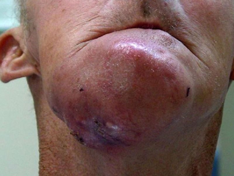 Ung thư xương hàm là căn bệnh hiếm gặp