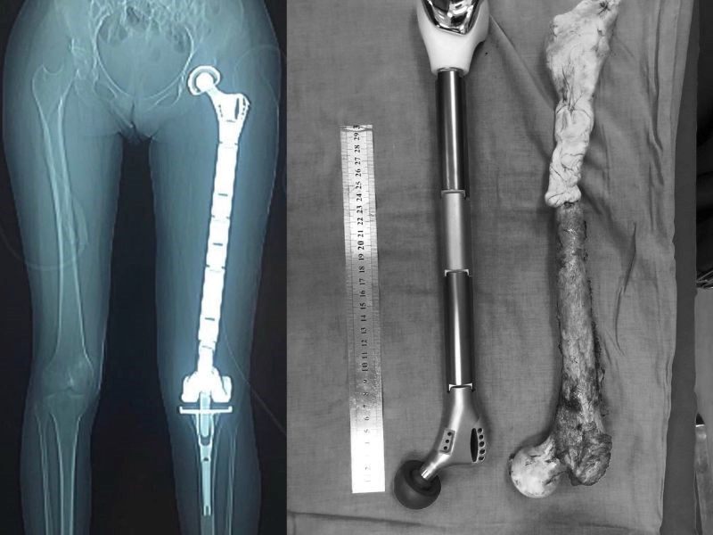 Ung thư xương là căn bệnh nguy hiểm, ảnh hưởng tới sức khỏe và sinh hoạt của người bệnh