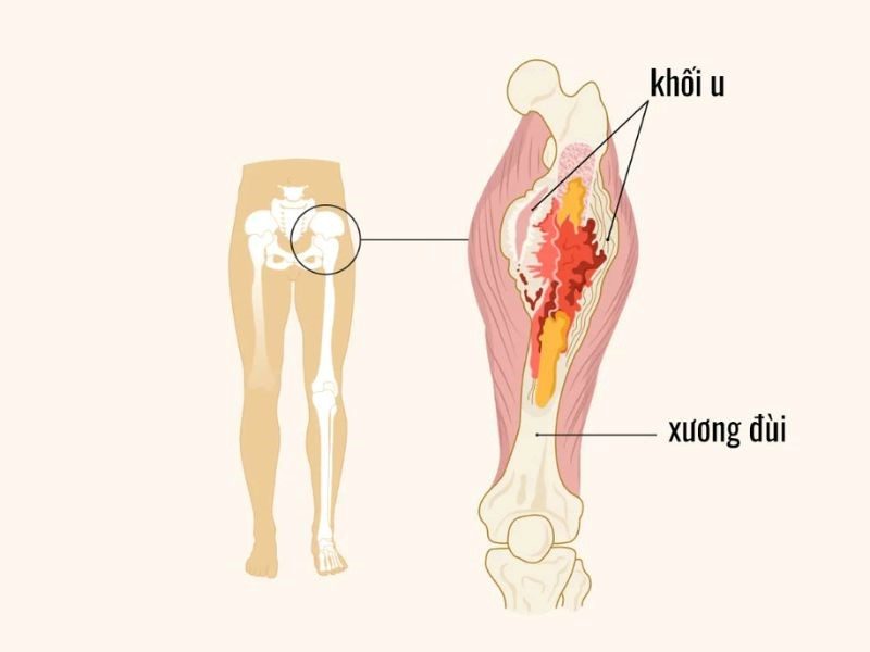 Yếu tố ảnh hưởng tới thời gian sống của bệnh nhân ung thư xương