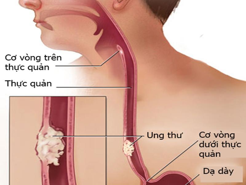Căn bệnh ung thư thực quản đang có xu hướng trẻ hóa