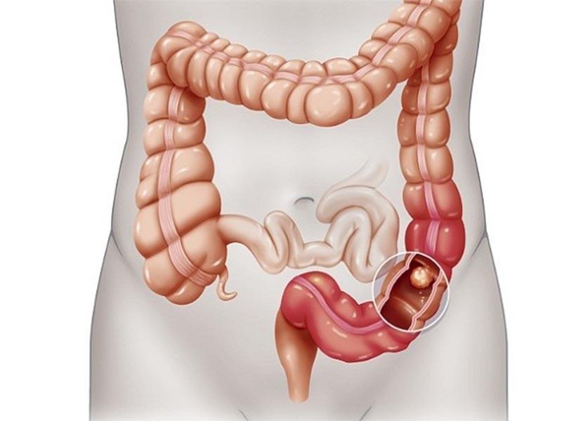 Nguyên nhân dẫn tới ung thư đại tràng sigma