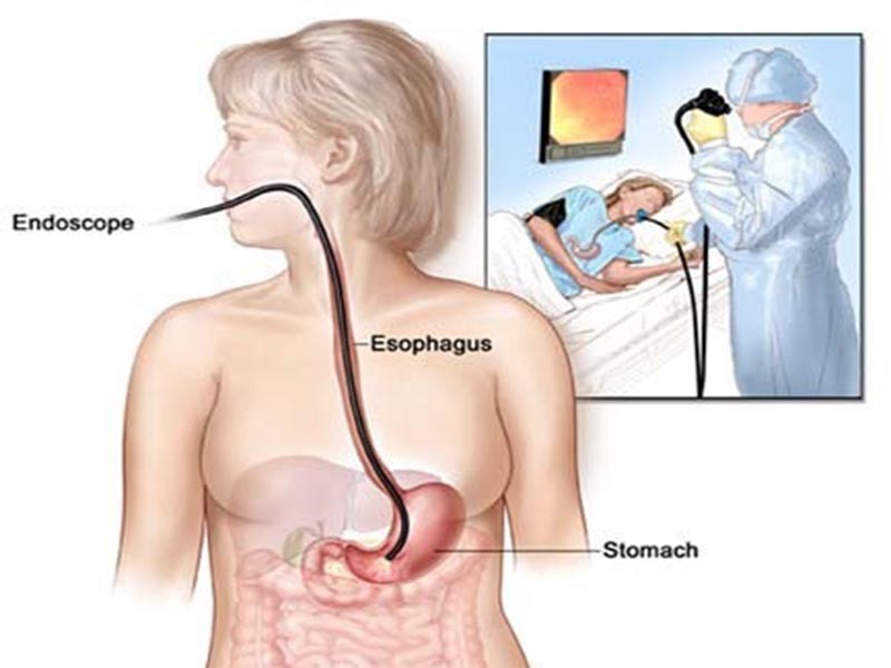 Phương pháp chẩn đoán ung thư thực quản