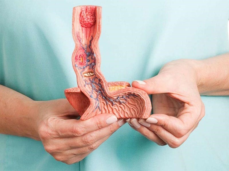 Tiên lượng sống của bệnh nhân mắc ung thư thực quản giai đoạn cuối