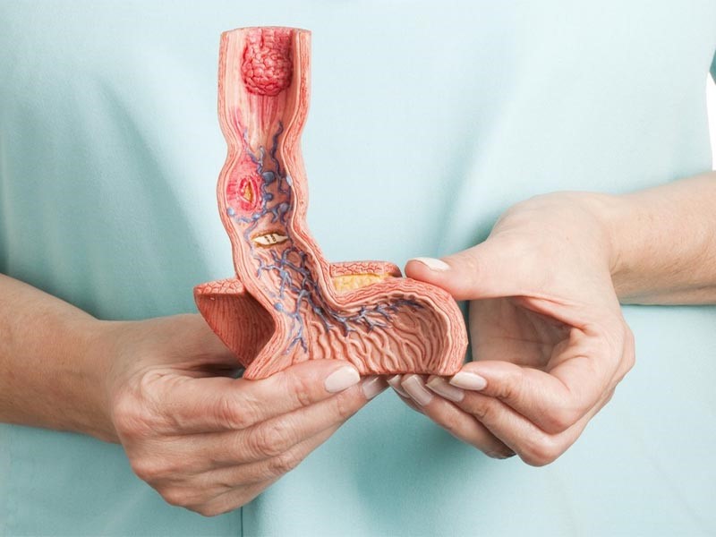 Ung thư thực quản có di truyền không?