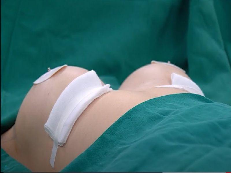 Phương pháp điều trị ung thư vú giai đoạn 1