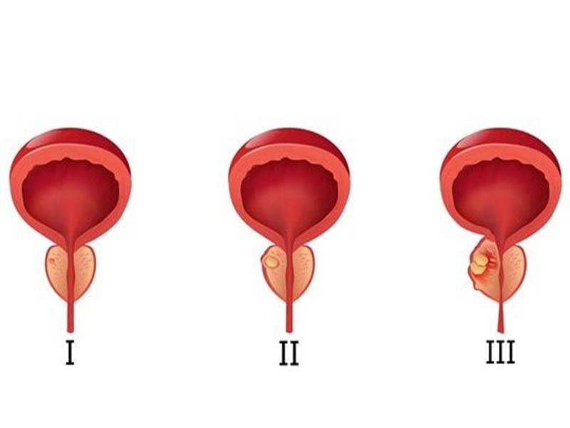 Tiên lượng sống của bệnh nhân mắc ung thư tuyến tiền liệt giai đoạn 3