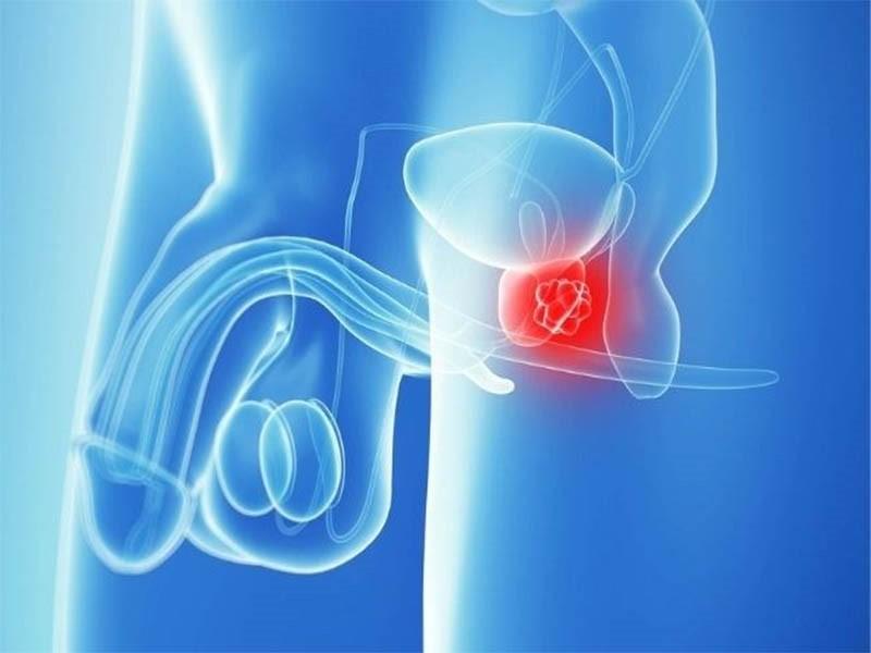 Ung thư tuyến tiền liệt