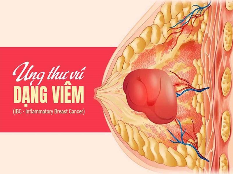 Ung thư vú dạng viêm hiếm gặp nhưng có mức độ nguy hiểm cao