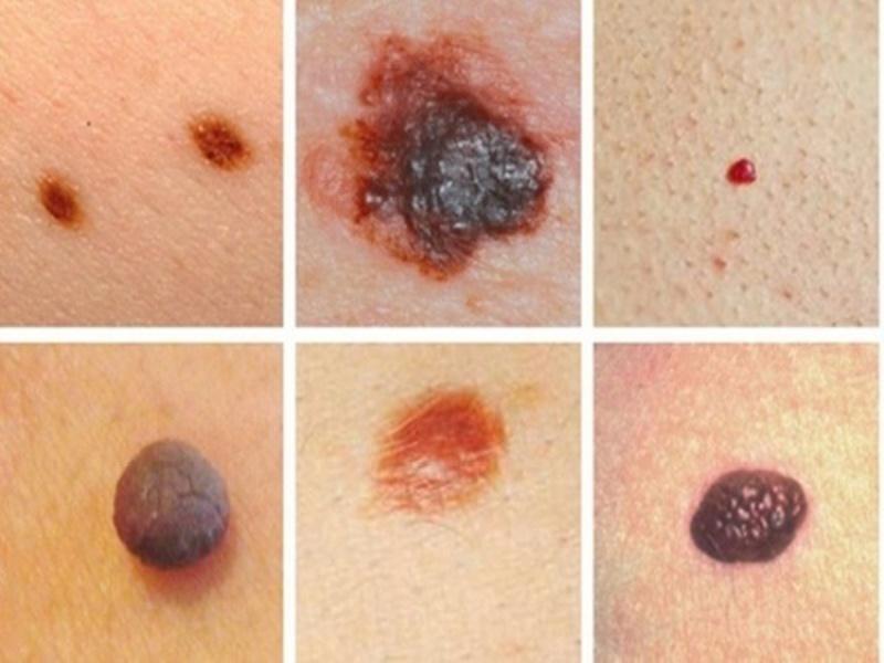 Bệnh nhân ung thư da nên ăn gì?