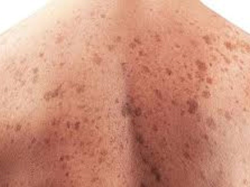 Biến chứng của bệnh ung thư da