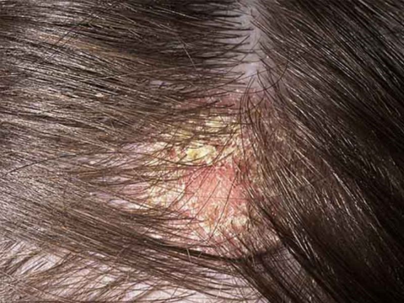 Các loại ung thư da đầu