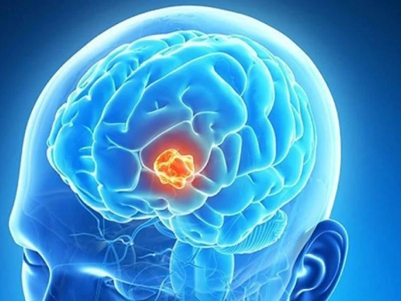 Các phương pháp điều trị ung thư não