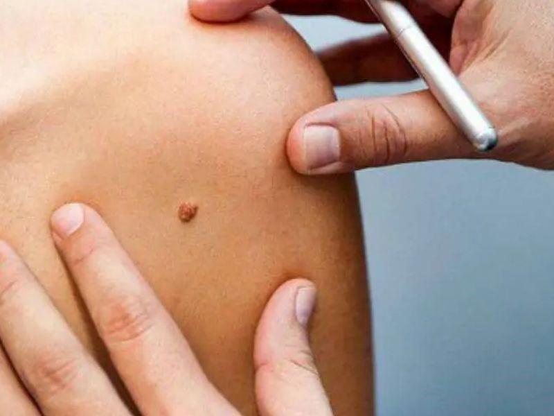 Các yếu tố làm tăng nguy cơ mắc ung thư da