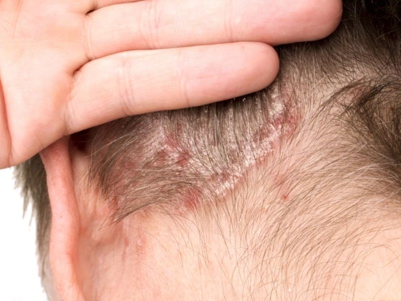 Căn bệnh ung thư da đầu