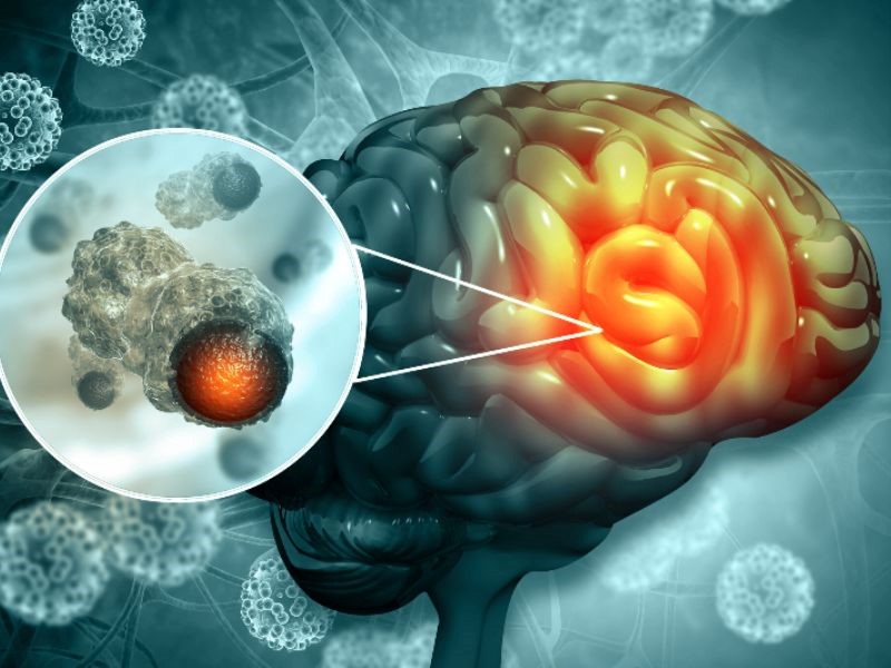 Căn bệnh ung thư não rất nguy hiểm