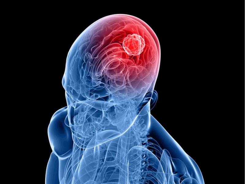 Chưa xác định được chính xác nguyên nhân gây ung thư não