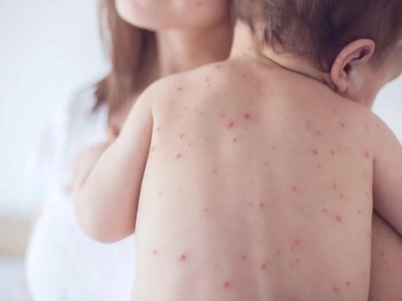 Dấu hiệu ung thư da ở trẻ em
