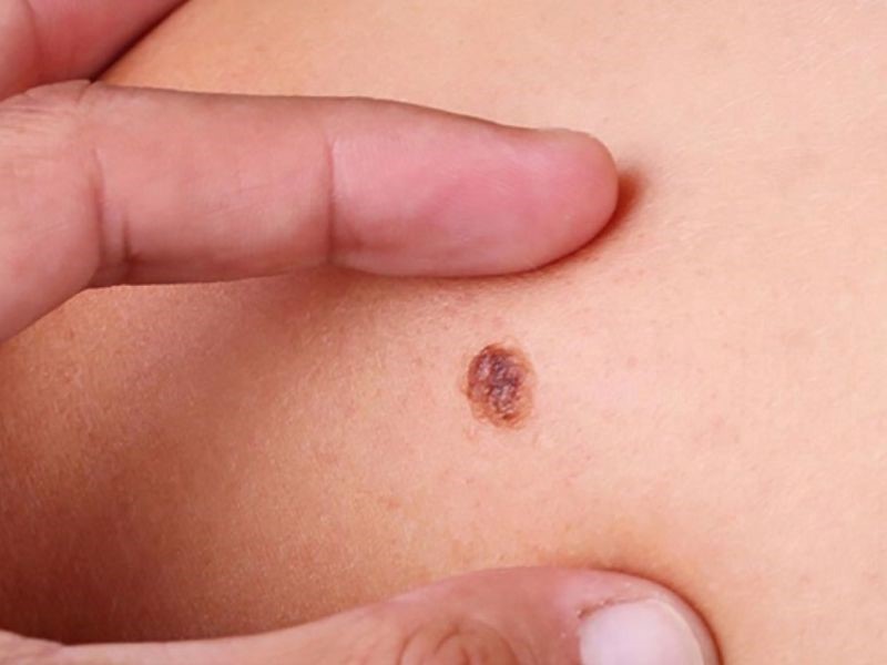 Nguy cơ mắc ung thư da