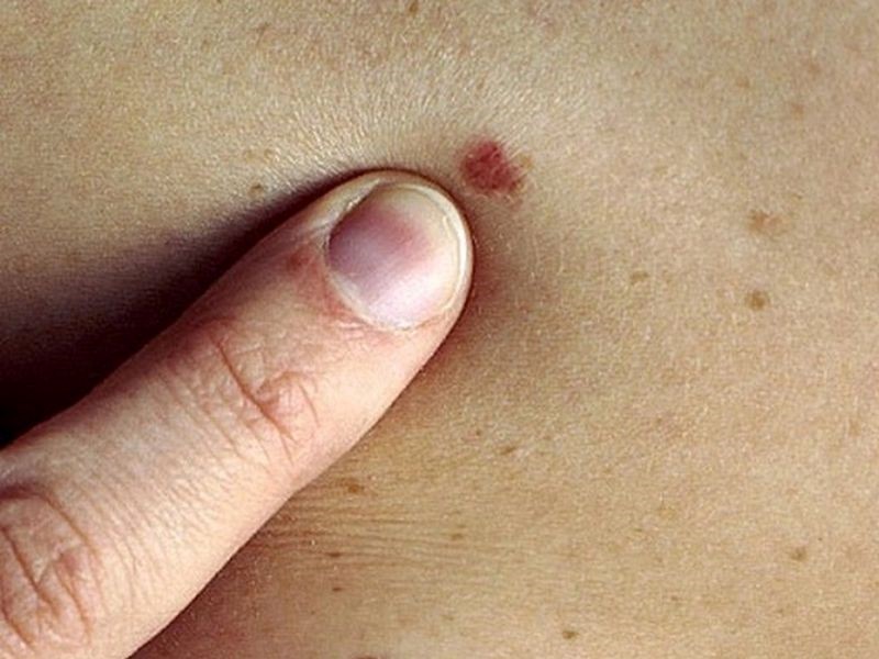 Nguyên nhân gây ung thư da