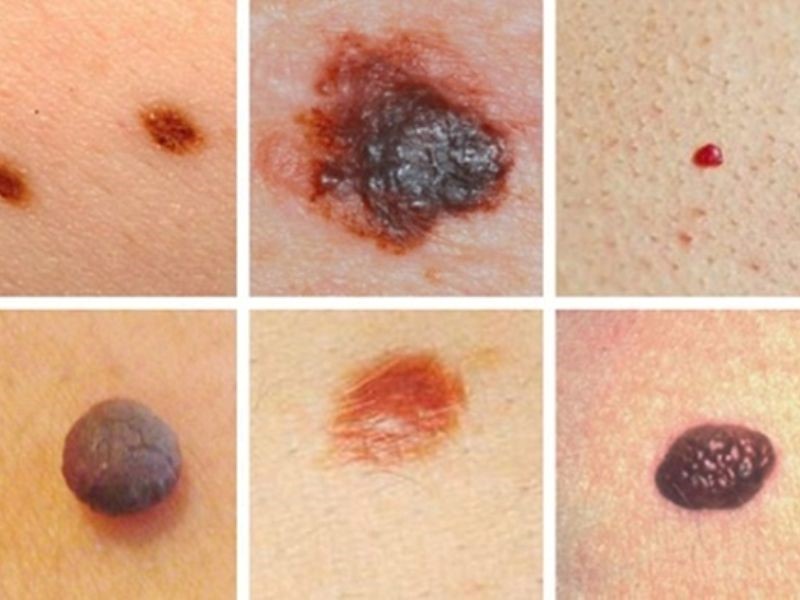 Nguyên nhân gây ung thư da