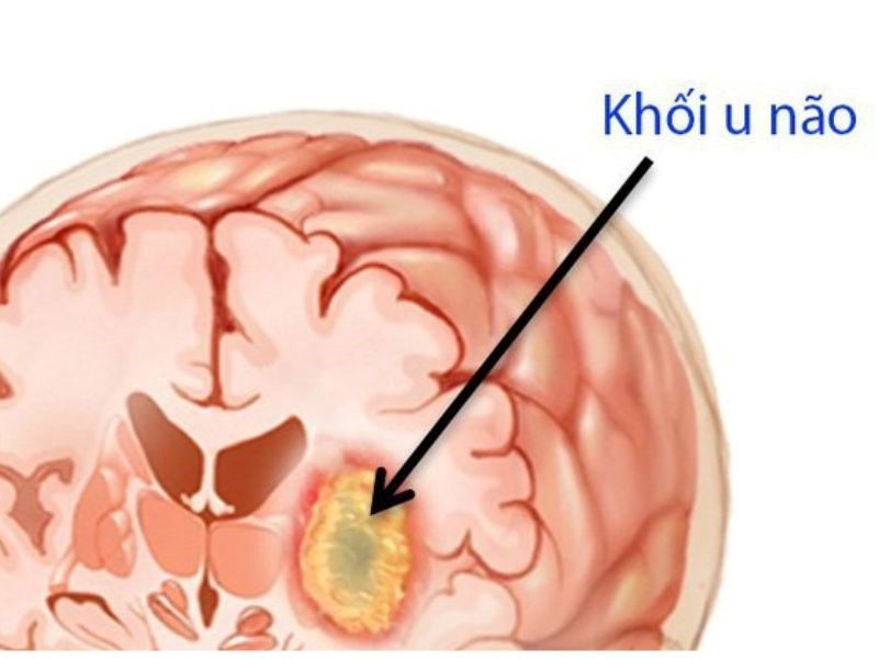 Phương pháp điều trị u não
