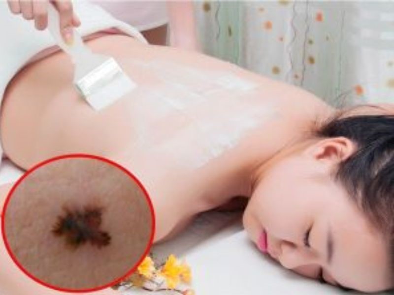 Tắm trắng có gây ung thư da?