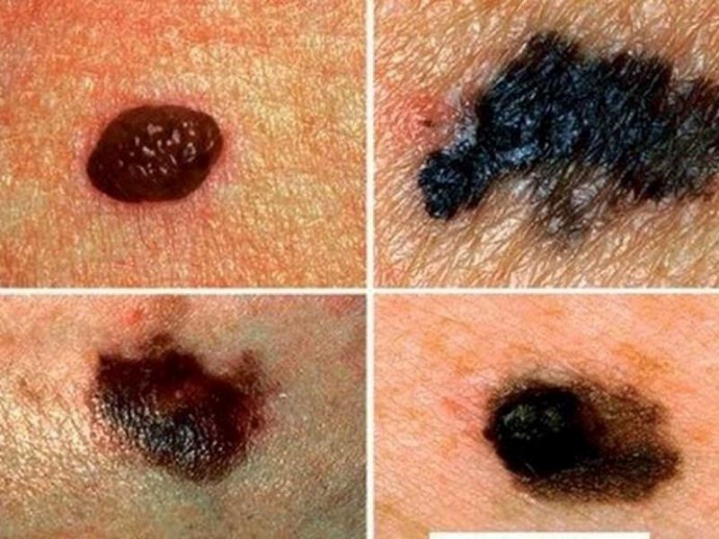 Tiên lượng bệnh nhân ung thư phụ thuộc vào nhiều yếu tố khác nhau